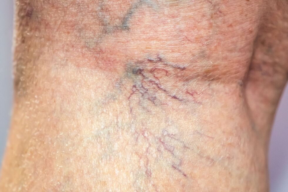 Varicose veins in the body