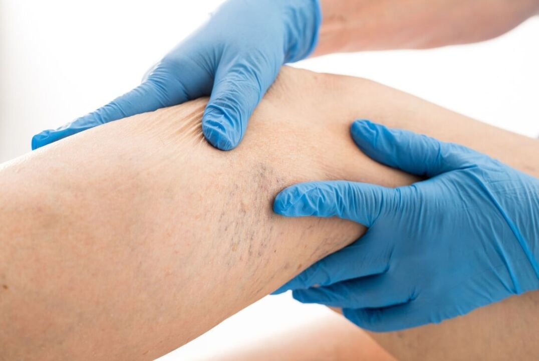 Clinical disease of cart varicose veins