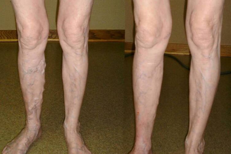 vein varicose veins in men