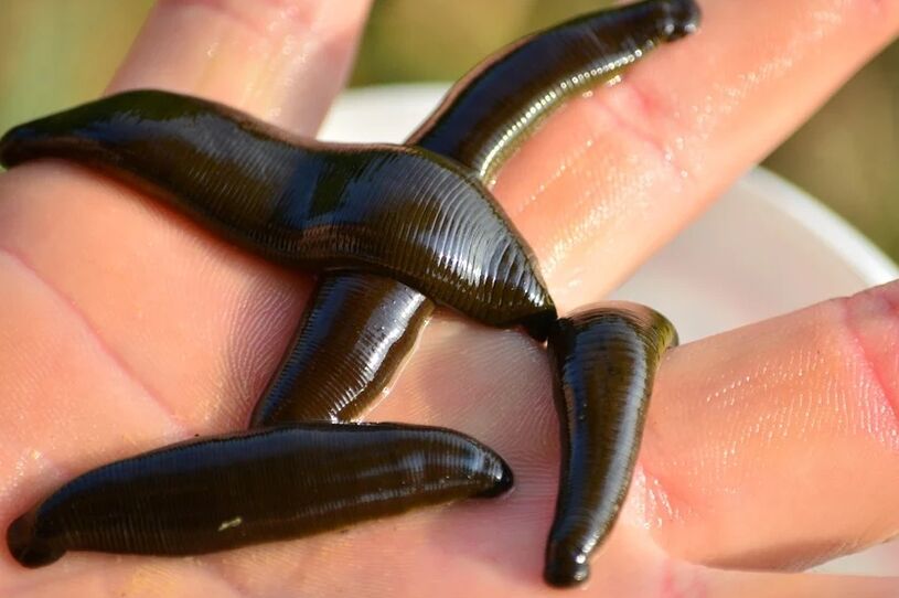 Leeches will help fight varicose veins