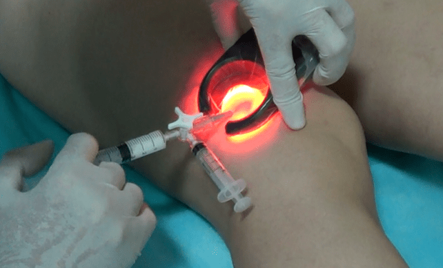 Sclerotherapy is an effective method of treating varicose veins in the legs