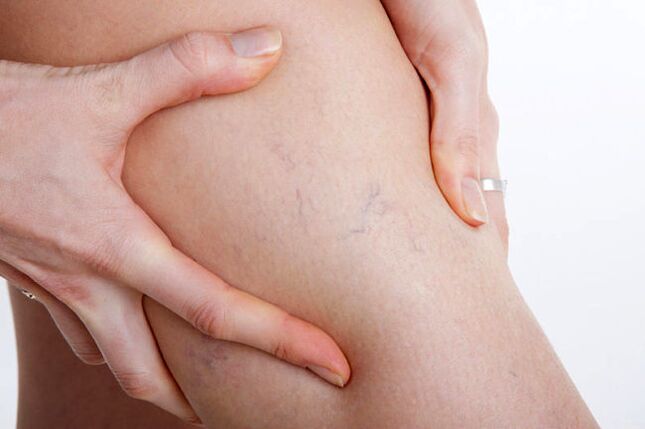 The first appearances of varicose veins in the leg