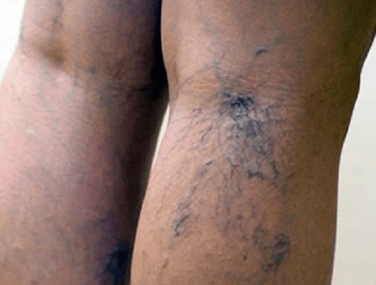 varicose veins in the legs